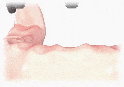 Об имплантации по методу All on 4